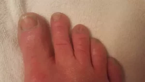 The toenail fungus starts cleaning up