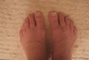 Toenail fungus removed with the CC Formula