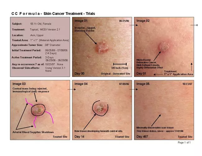 CC Formula treating melanoma skin cancer on arm
