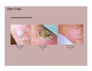 CC Formula Skin Cancer Trial