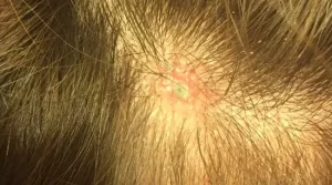 Skin cancer on scalp 