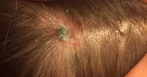 Skin cancer on scalp 