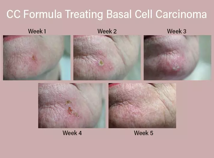 Carcinoma treatment with the CC Formula