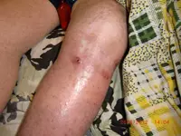 Tratamiento de la infección por SARM en las piernas con la fórmula CC