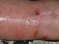 Tratamiento de la infección por SARM en las piernas con la fórmula CC