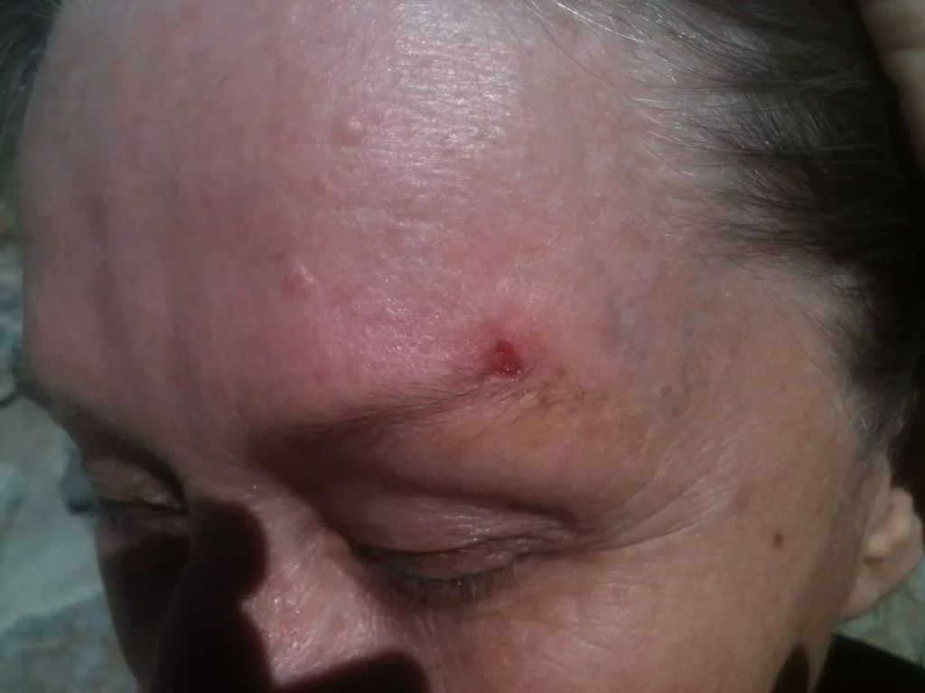 Squamous Cell Carcinoma over the eyebrow