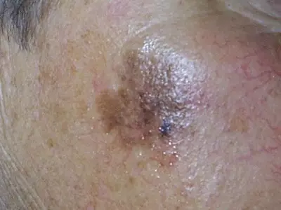 Skin cancer on cheek